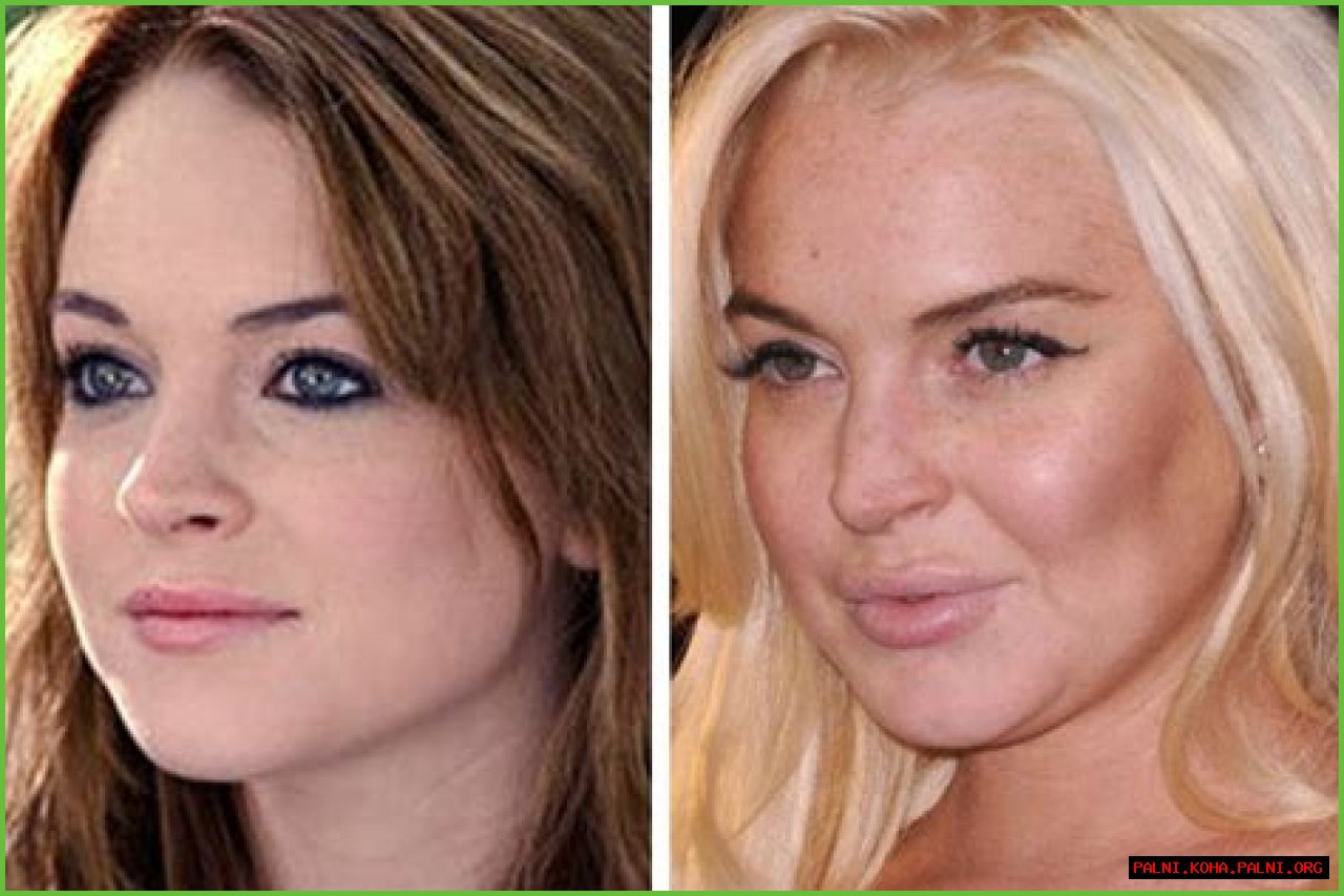 Unveiling The Secrets Of Lindsay Lohan's Nose Job: Discoveries And Insights